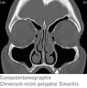 Computertomographie Chronisch-nicht-polypöse Sinusitis Computertomographie Chronisch-nicht-polypöse Sinusitis