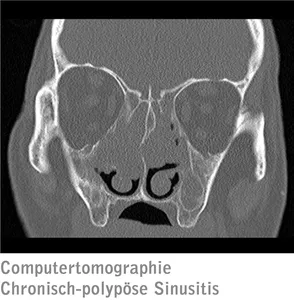 Computertomographie Chronisch-polypöse Sinusitis Computertomographie Chronisch-polypöse Sinusitis