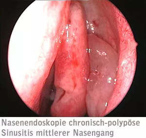 Nasenendoskopie chronisch-polypöse Sinusitis mittlerer Nasengang Nasenendoskopie chronisch-polypöse Sinusitis mittlerer Nasengang