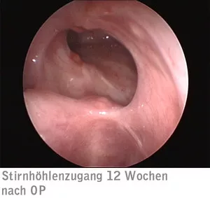 Stirnhöhlezugang 12 Wochen nach OP Stirnhöhlezugang 12 Wochen nach OP